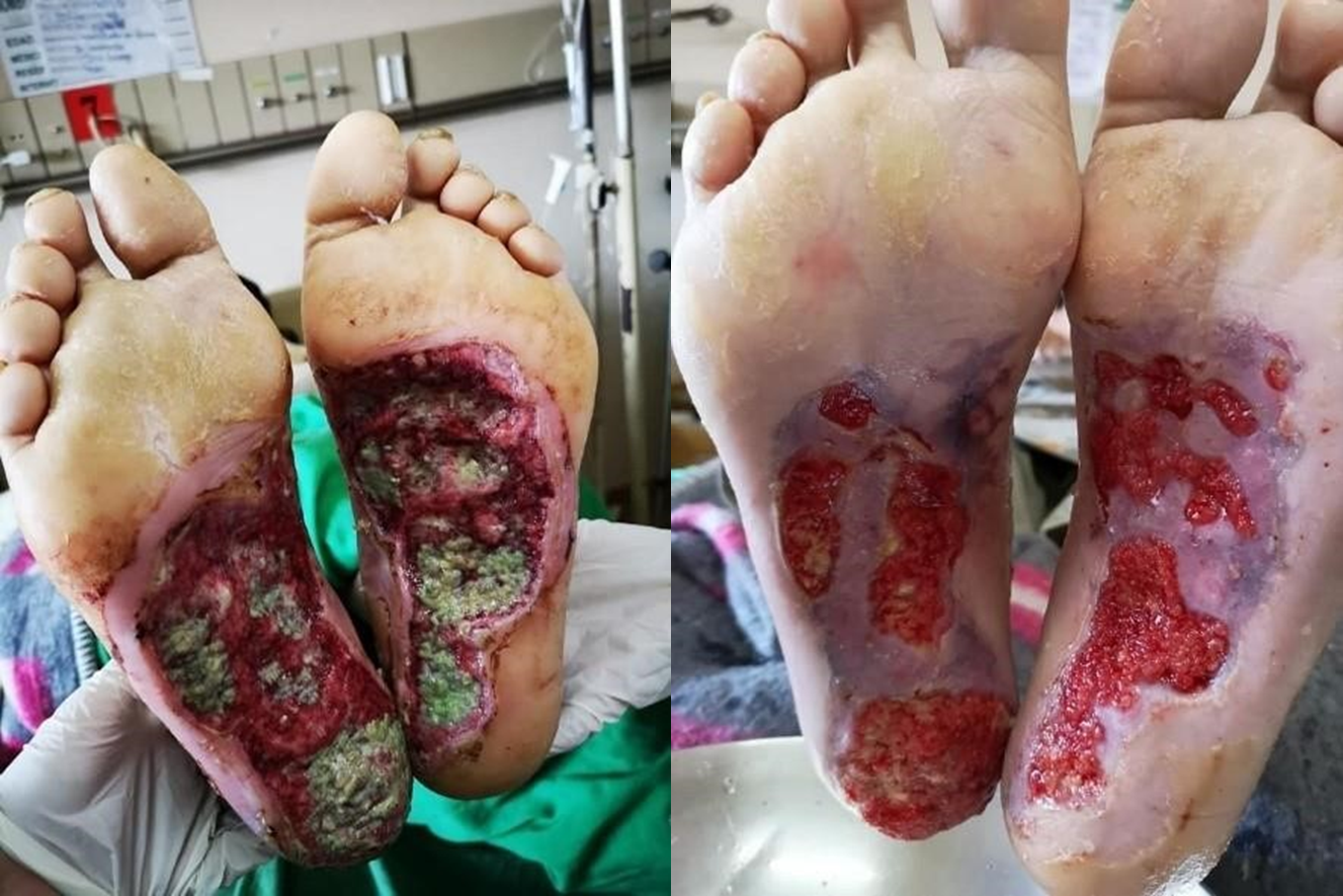 Before & After: Gangrene